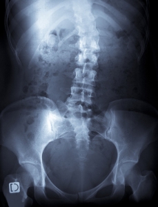 bigstockphoto_X-Ray_Of_A_Young_Female_Spine_2761706